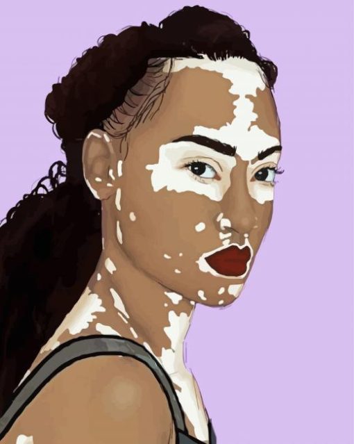 Vitiligo Woman Art Diamond Painting